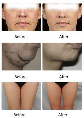 Ultherapy tightens your skins and shapes