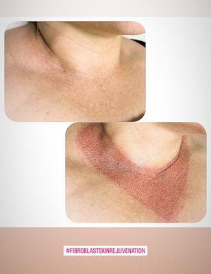 Plasma fibroblast skin tightening