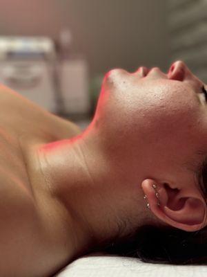 Chin Lipo 1 week post op