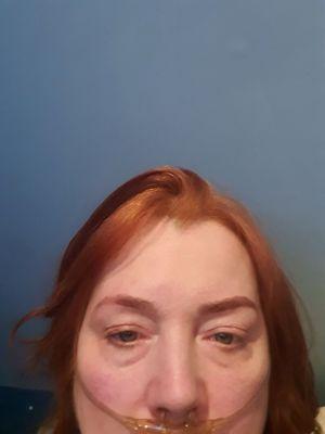 She used threading and pulled bald spot in left eyebrow.