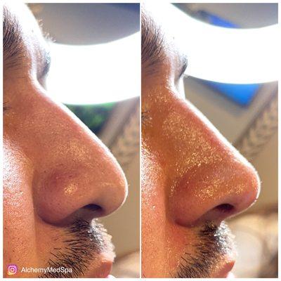 Non surgical nose augmentation