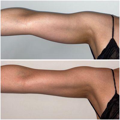 Arms after 2 weeks (4 sessions)