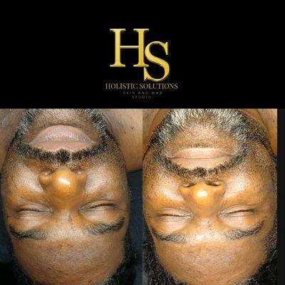 Hyperpigmentation GQ Experience