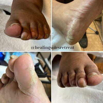 Before a dry pedi by Jesie. #drypedicure #CMNT #medicalnailtech specializing is pedicures for those who are at risk #diabeticfootcare