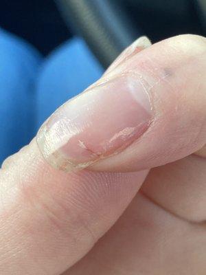 The nail bed injury I received