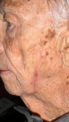 7 Nov 2022; Scar barely noticeable, I'm able to shave normally. Thank you, Dr. Lamerson