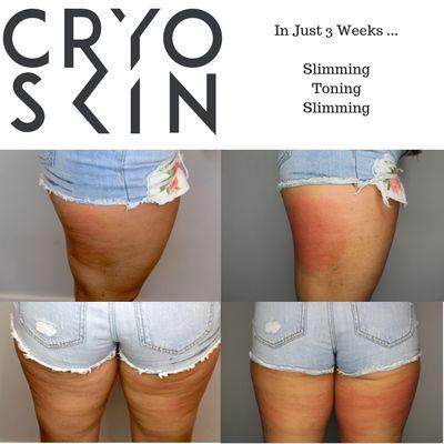 Alternating between CryoSlimming and CryoToning- Female before and after