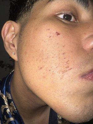 Scarring from facial wax