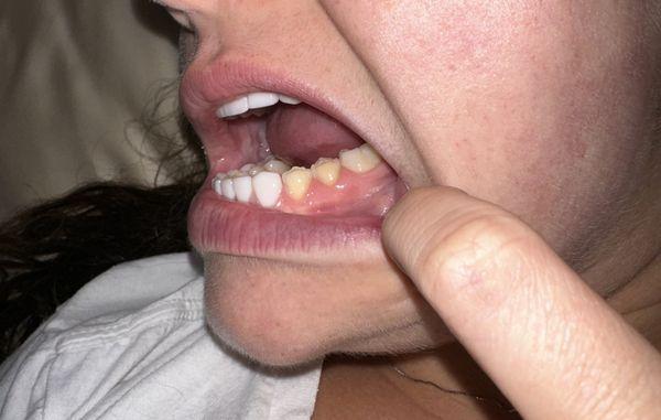 More veneers popping off