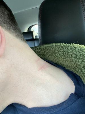 Broke the skin with the buzzer