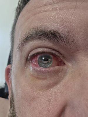 My eye they saved after a retinal detachment. Started having issues at 5 pm. They called the ER and helped me into surgery the next morning!