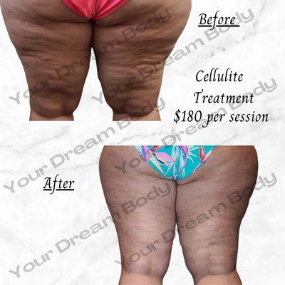 Three months after first treatment of cellulite correction. .