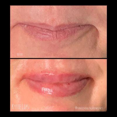 Restylene Kysse filler for the win!