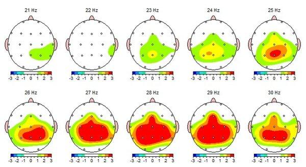 An example of a brain map report. A brain map is the initial neurofeedback evaluation, giving information on brain function and symptoms.