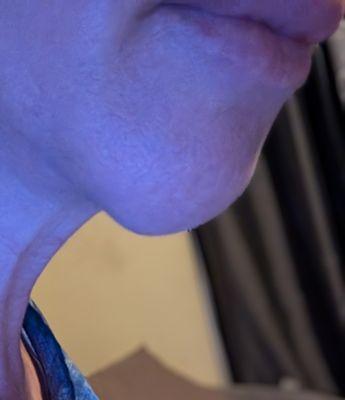 Just proof. My implant is visibly under my chin. That's the bump underneath and YES it is very uncomfortable.
