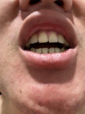 Before and after photo of my tooth break.