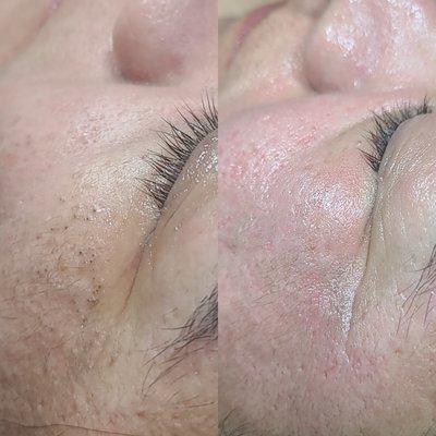 Before and after of a Deep Cleansing Facial
Extractions performed during service
Esthetician IG @NicoleRoyaltySkin
