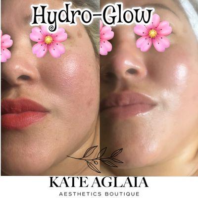 Hydro-Glow Facial