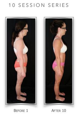 Before & After 10-Series of Structural Integration