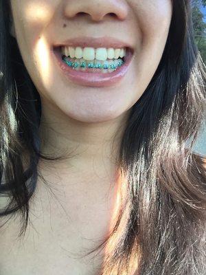 08/2015 Got my lower braces first.