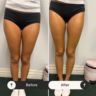 Anaheim Body Sculpting