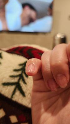 A week later, my nails have dents bc they're so thin. Still sore and it hurts whenever I touch or grab something. Unacceptable.