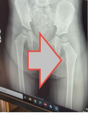 I'm no radiologist, but I spotted the break. They couldn't...Can you?