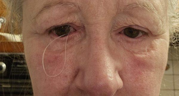 Stent coming out of my eye at 6 weeks after surgery. Had to cut and pull out on my own.