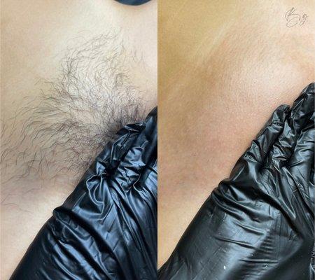 Brazilian Wax Before & After