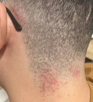 The machine that was used on me was dull and kept ripping out hair it was clearly not sanitized properly as it gave me a skin infection.