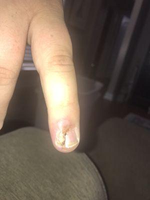 My son's infected finger.