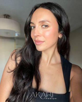 Patient selfie.
Chin filler by our master-certified injector, NP Isabel (Izzy).
Call or text 949-232-0301 to book!