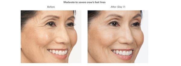 Significant reduction in crows feet lines at corners of eye. Results typically last 3-4 months.
