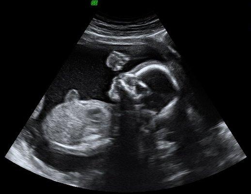 Amazing Baby 3D Ultrasound