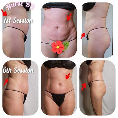 Wood therapy, Cavitation and RF skin tightening