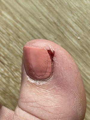 1 day after pedicure. Just waiting for infection to flare up from skin being ripped off
