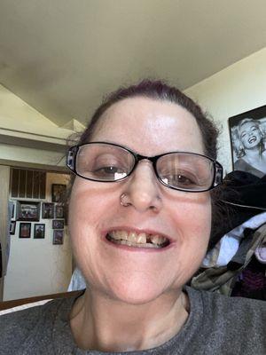 Broken tooth after losing a filling and not getting it taken care of before the tooth broke (been dealing with my husband's death).