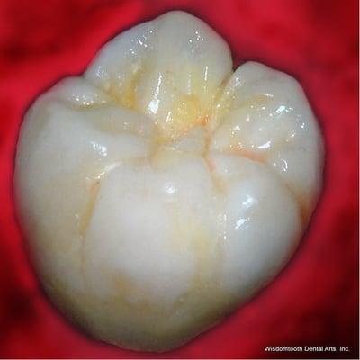 Actual TruArt Diagnostic Wax-up