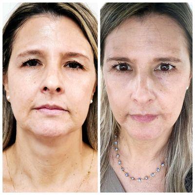 Laser Lift & Resurface tightens the skin while improving texture, tone, & radiance for a more youthful appearance. Cumulative Results