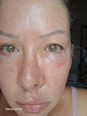 My eye with a bump I've had for four weeks after cheek injections