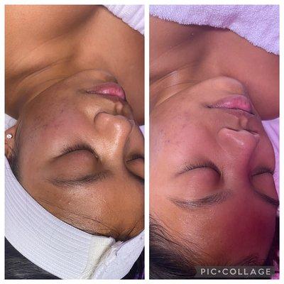 Before & After Facial