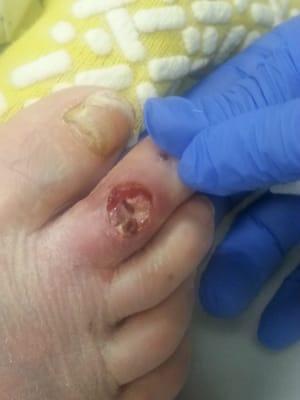 Exposed bone due to negligence from MP