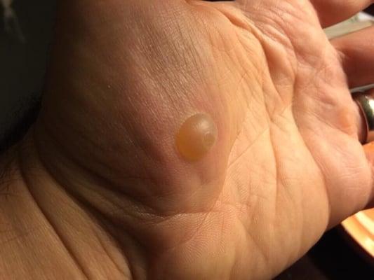 Atlanta Center For Dermatologic Diseases