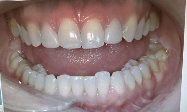 My teeth before any drilling