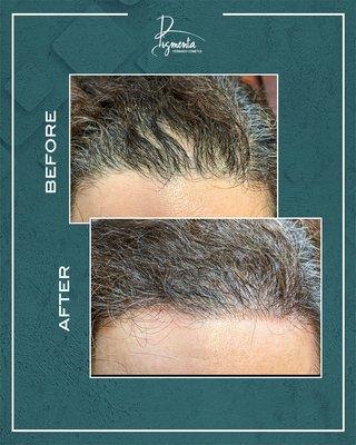 Scalp Micropigmentation
Clean hairline design creates a fuller, more defined look.