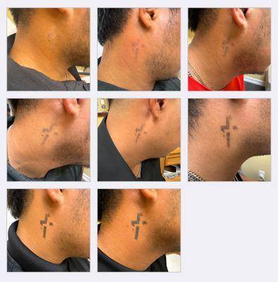 Laser Tattoo Removal by Tatt Cemetery