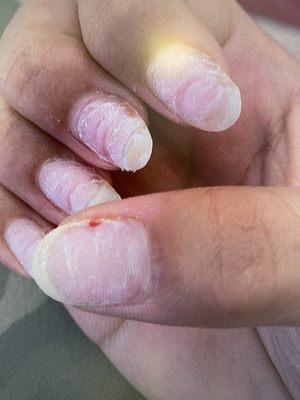 What my look like after I took the off because they were hurting and burning with the nail glue my nails have never been this bad