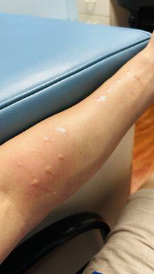 Allergy prick skin test results fast within 20 minutes. No pain or marks left behind. Test for indoor outdoor environment and food