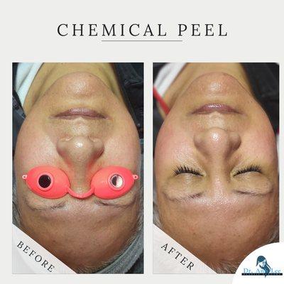 Chemical Peel