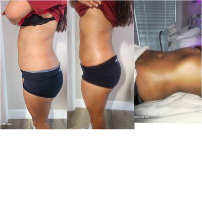 Slimming Belly treatments
Slimming Belly treatments